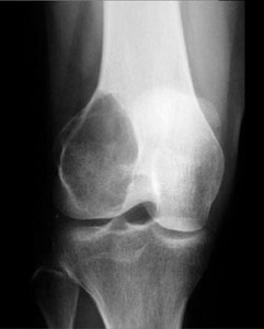 X-ray of the knee joint showing an eccentric lytic lesion at the epiphysis/metaphysis region of the distal femur consistent with Giant Cell Tumor of bone