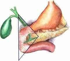 Anatomical illustration showing the gastrinoma triangle (Passaro's triangle) bounded by the cystic duct, duodenum, and pancreatic neck