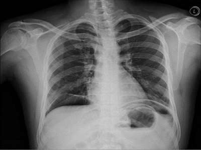 Chest X-ray showing air under the left hemidiaphragm (pneumoperitoneum) consistent with hollow viscus perforation