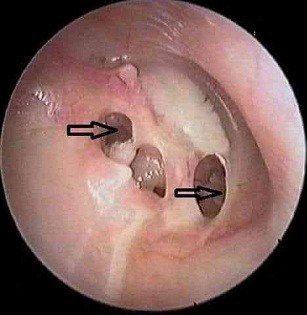 Otoscopic view showing multiple perforations of the tympanic membrane consistent with tubercular otitis media
