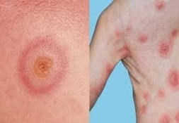 Two clinical photographs showing erythematous macular rash and positive alpha-hemolysis on culture plate consistent with Streptococcus pneumoniae infection