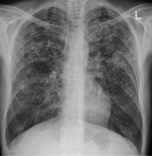 Chest X-ray (PA view) showing bilateral diffuse miliary nodular opacities throughout both lung fields consistent with miliary tuberculosis