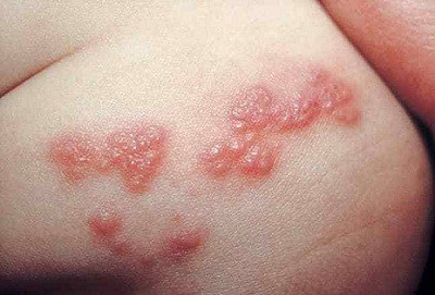 Clinical photograph showing grouped vesicular lesions on erythematous base in a dermatomal distribution on the trunk consistent with herpes zoster (shingles)