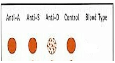 Image of blood grouping slide test showing: Anti-A no clumps, Anti-B no clumps, Anti-D clumping, Control with oval red cells - consistent with D antigen (Rh group) testing