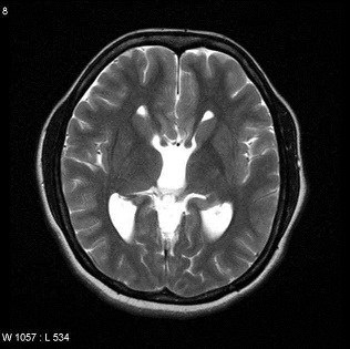 Axial MRI of the brain showing widely spaced lateral ventricles with a 'racing car sign' consistent with callosal dysgenesis/agenesis of corpus callosum