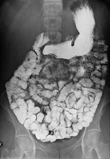 X-ray image of the abdomen showing contrast outlining the entire small bowel in a barium meal follow-through study