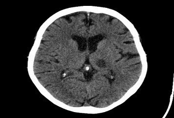 Axial CT scan of the brain showing a small hyperdense lesion in the thalamic/basal ganglia region consistent with a lacunar infarct