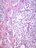 H&E showing large cells with clear cytoplasm, prominent nuclei and lymphocytic infiltration in fibrous septa - seminoma