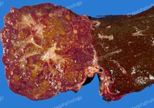Gross liver specimen showing a well-circumscribed mass with central stellate scar - Focal Nodular Hyperplasia