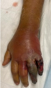 Clinical image of hand showing swollen, discolored tissue with moist necrosis - wet gangrene after traumatic injury