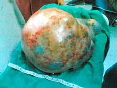 Gross specimen of ovarian cystic mass with smooth surface and thin walls containing clear fluid - serous cystadenoma