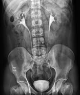 Intravenous pyelogram (IVP) showing contrast-filled renal pelvis, ureters and bladder