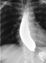 Barium swallow showing dilated esophagus with bird-beak narrowing at gastroesophageal junction - achalasia cardia