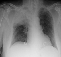 Chest X-ray showing homogeneous opacity in right lower zone with air bronchogram - right lung consolidation (pneumonia)