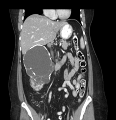 CT abdomen showing heterogeneous enhancing mass in right renal fossa - renal cell carcinoma