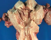 Gross specimen of uterus showing polypoid fungating mass filling the uterine cavity - endometrial carcinoma