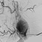 Carotid angiography showing splaying of carotid bifurcation with hypervascular mass - Lyre sign of carotid body tumor