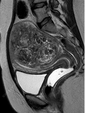 MRI pelvis showing well-defined hypointense intramyometrial mass - intramural fibroid