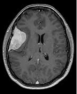 Brain MRI showing extra-axial homogeneous enhancing mass with dural tail - meningioma
