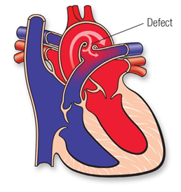 Diagram of heart showing PDA (patent ductus arteriosus) - defect from persistence of left 6th pharyngeal arch artery