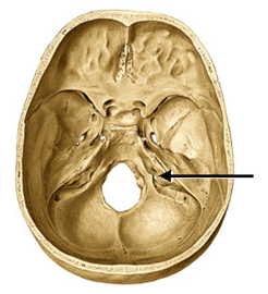 Skull base image with arrow pointing to jugular foramen