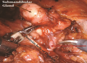 Surgical field of submandibular gland excision with arrow pointing to facial artery looping over the gland
