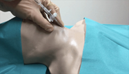 Clinical image showing cricothyrotomy procedure - emergency airway access through cricothyroid membrane