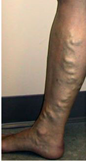 Clinical image of left leg showing dilated tortuous varicose veins with skin pigmentation