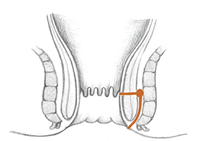 Diagram of anal canal showing fistula tract between internal and external sphincters - intersphincteric fistula