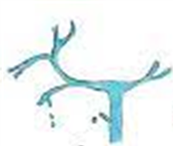 Diagram of bile duct showing Type A Strasberg injury - cystic duct leak after laparoscopic cholecystectomy