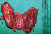 Gross specimen of total thyroid gland excision - risk of parathyroid injury causing hypocalcemia
