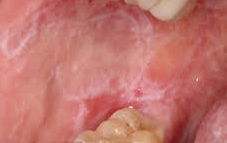 Clinical image of oral mucosa showing white striae with erosions - oral lichen planus