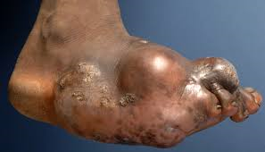 Clinical image of foot with swelling and multiple sinuses discharging black grains - eumycetoma (Madura foot)