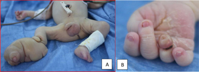 Newborn with amniotic band syndrome showing ring constrictions and digit amputations of upper limb