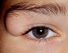 Clinical image showing smooth, non-tender swelling at lateral eyebrow in a 5-year-old girl - dermoid cyst
