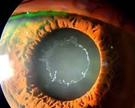 Slit lamp image showing white exfoliative material on anterior lens capsule - pseudoexfoliation syndrome