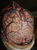 Autopsy image of brain showing purulent exudate over meninges - meningococcal meningitis