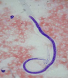 Peripheral blood smear showing Wuchereria bancrofti microfilaria - curved sheathed larva